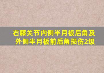 右膝关节内侧半月板后角及外侧半月板前后角损伤2级